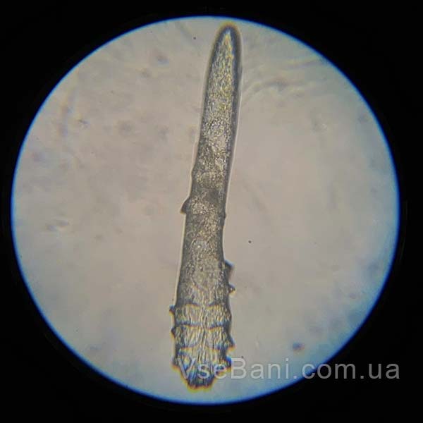 Как избавиться от акне 