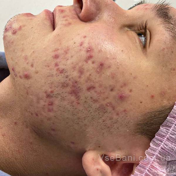 Угревая болезнь на лице
