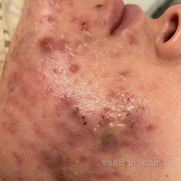 Воспалительная форма угревой болезни