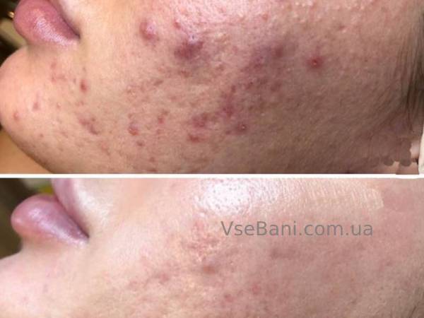 Как избавиться от красных прыщей