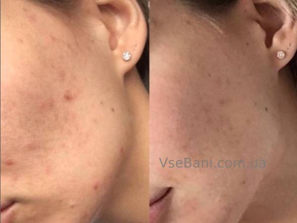 Как избавиться от красных прыщей