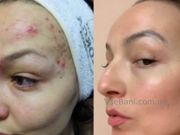 Как избавиться от прыщей на лбу