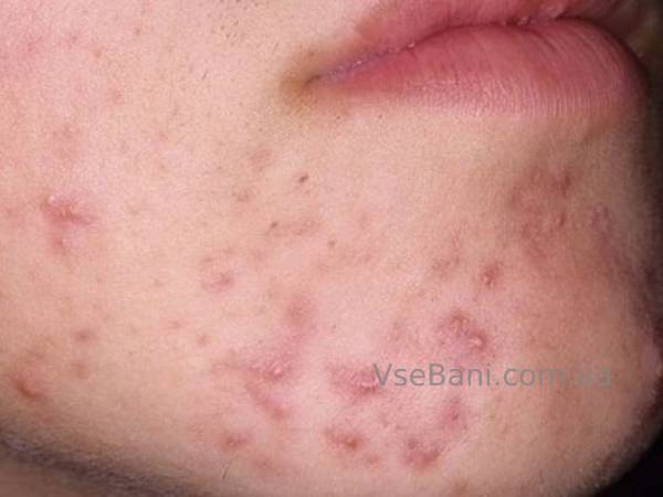 Как избавиться от прыщей на подбородке