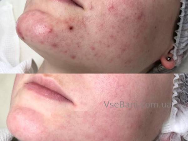 Как избавиться от прыщей на подбородке