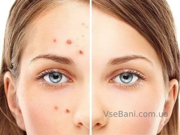 Как избавиться от прыщей за 1 день