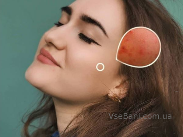 Как избавиться от подкожных прыщей Как избавиться от подкожных прыщей