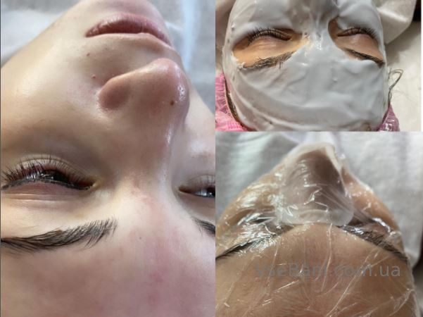 Как избавиться от подкожных прыщей Как избавиться от подкожных прыщей