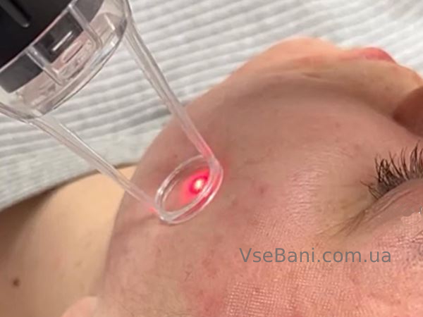 Как убрать пятна на лице после прыщей