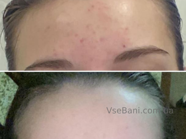 Как убрать пятна на лице после прыщей