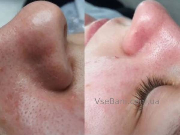 Как убрать черные точки на носу у подростка в домашних условиях Как убрать черные точки на носу у подростка в домашних условиях