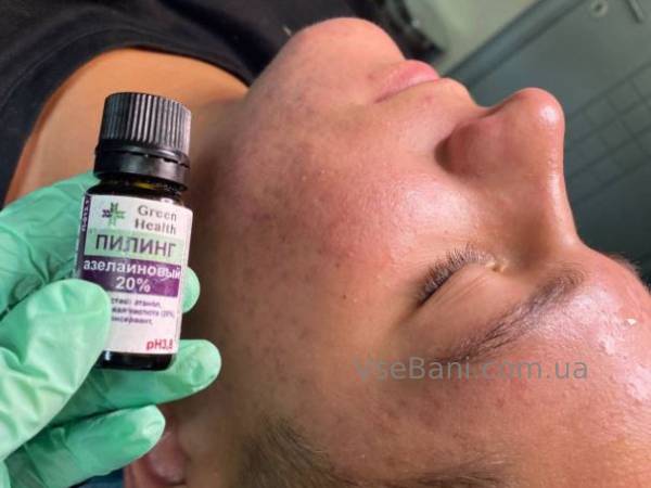 Как убрать черные точки на носу у подростка в домашних условиях Как убрать черные точки на носу у подростка в домашних условиях