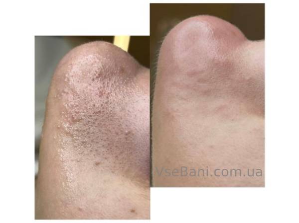 Как убрать черные точки на носу у подростка в домашних условиях Как убрать черные точки на носу у подростка в домашних условиях