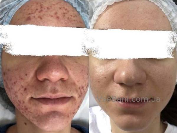 Лечение акне