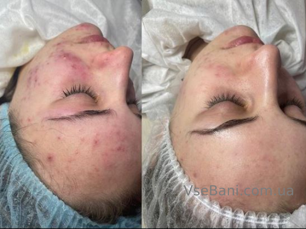 Лечение акне