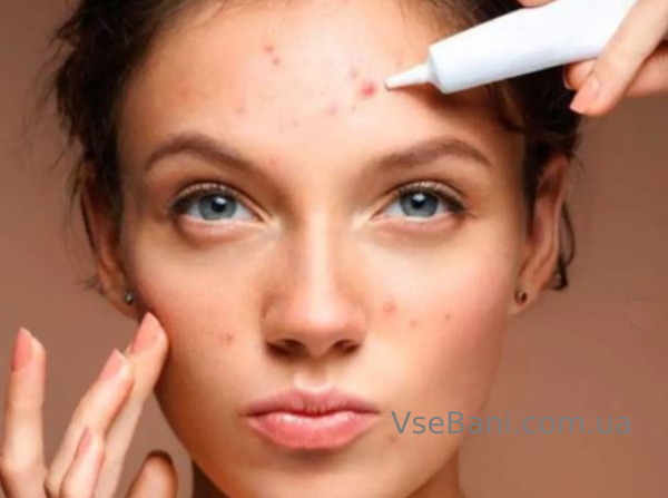 Лечение акне