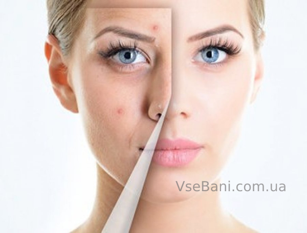 Лечение акне