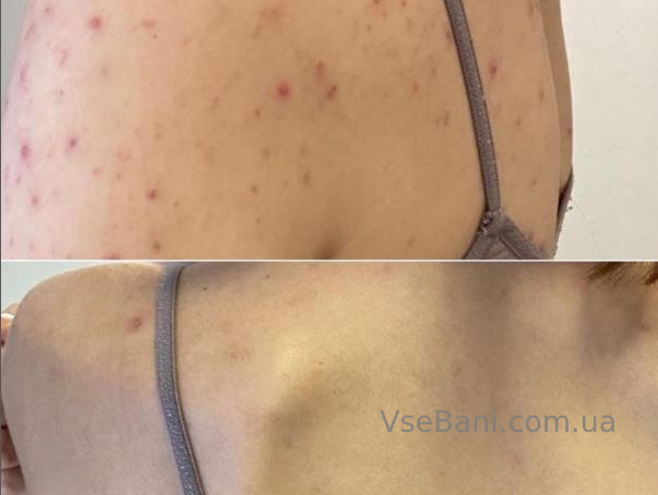 Лечение постакне Лечение постакне