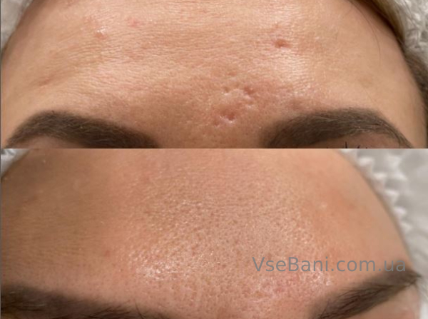 Лечение постакне Лечение постакне