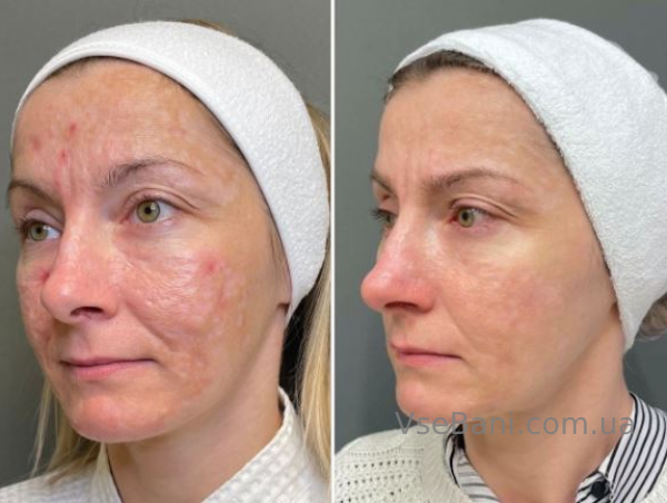 Лечение постакне Лечение постакне