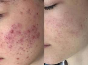 Как избавиться от ран после прыщей