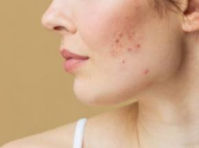 Лечение постакне