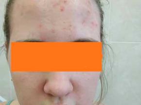 Аллергическая сыпь на лице