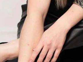 Аллергическая сыпь на руках