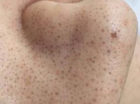 Черные точки на родинке