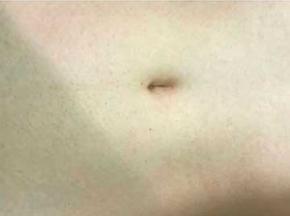 Черные точки на животе у человека