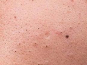 Чёрные точки на половых губах