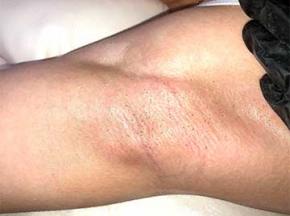 Чёрные точки под мышками