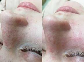 Домашняя маска от черных точек