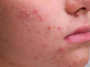 Как избавиться от акне