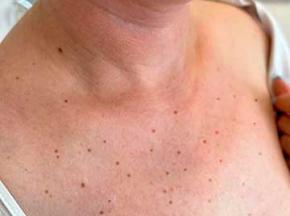 Как избавиться от черных точек на груди