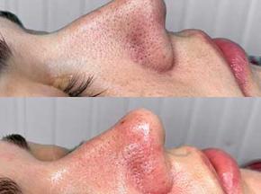 Как избавиться от черных точек на носу