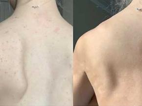 Как избавиться от черных точек на спине