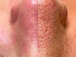 Как избавиться от чёрных точек в домашних условиях