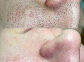 Как избавиться от комедонов на лице