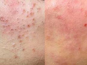 vsebani-com-ua-blog-krasota-kak-izbavitsya-ot-otkrytykh-komedonov-7