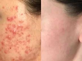 Как избавится от покраснения от прыщей