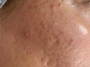 Как избавиться от постакне