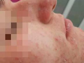 Как избавиться от прыщей и черных точек