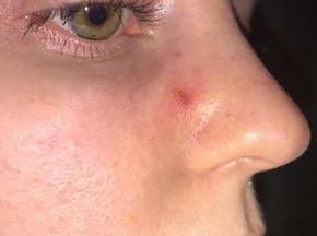 Как избавиться от прыщей на лице за одну ночь