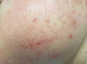 Как избавиться от прыщей на щеках