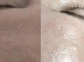 Как избавиться от сыпи на лбу