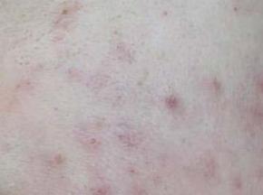 Как избавиться от сыпи на попе