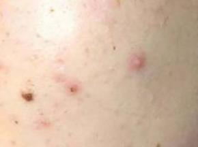 Как избавиться от сыпи на руках