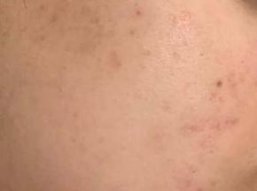 Как избавиться от сыпи на щеках