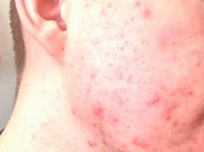 Как избавиться от вульгарных угрей