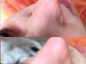 Как очистить кожу от черных точек